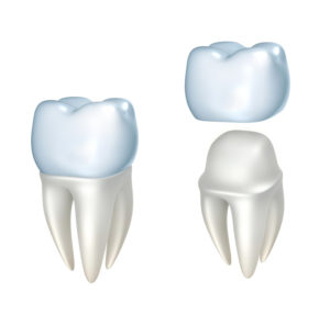 dental crowns